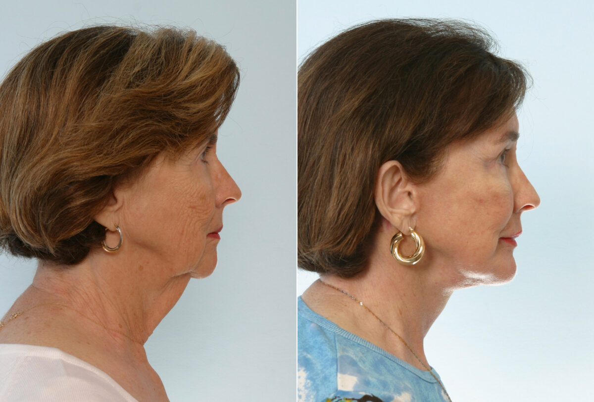 Chin Augmentation before and after photos in Houston, TX, Patient 28005