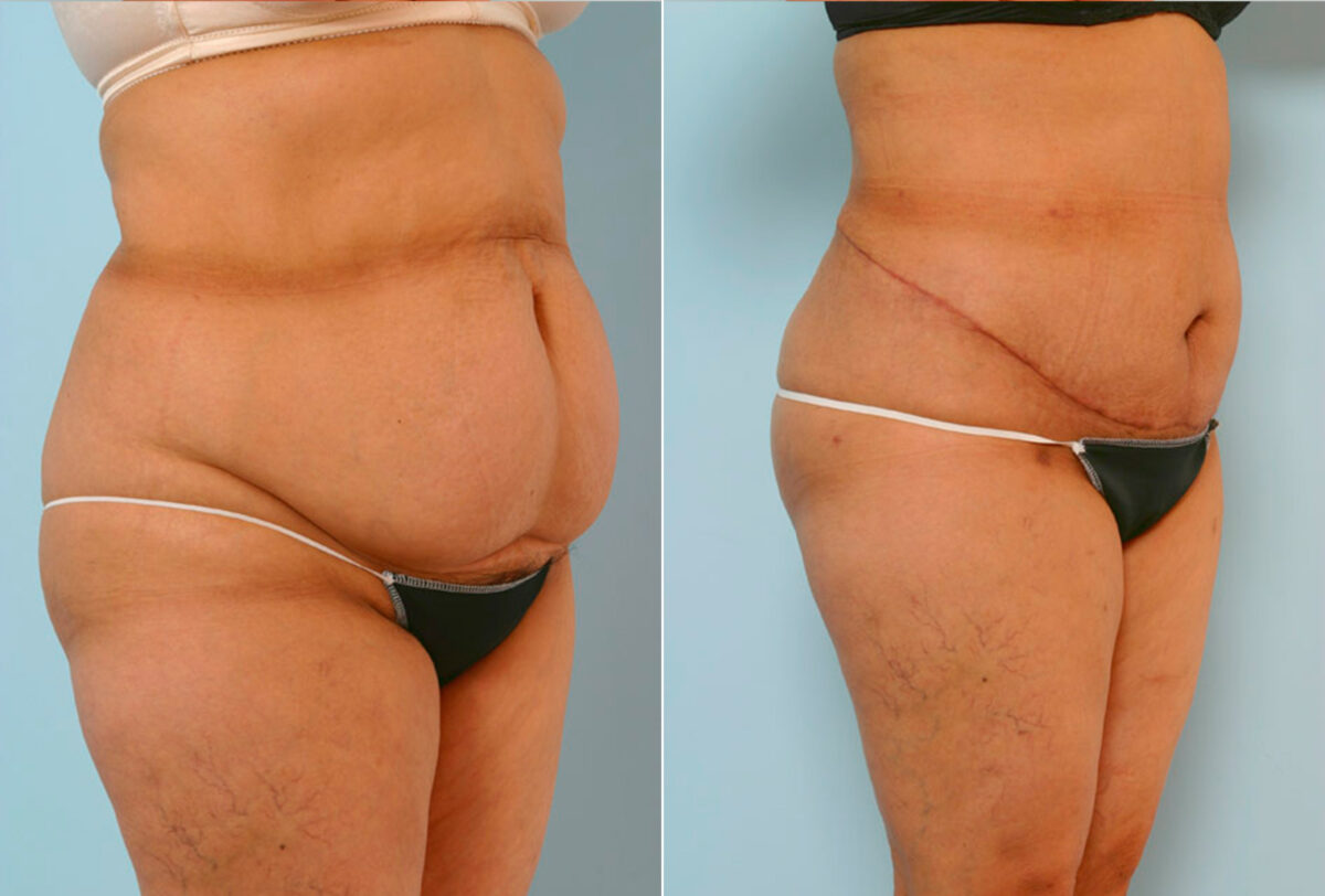 Abdominoplasty before and after photos in Houston, TX, Patient 24579