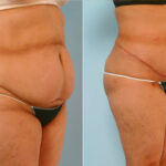 Abdominoplasty before and after photos in Houston, TX, Patient 24579