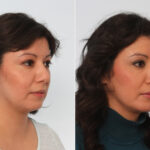 Chin Augmentation before and after photos in Houston, TX, Patient 28015