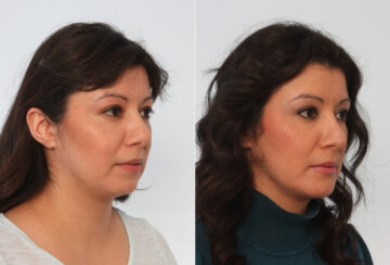 Chin Augmentation before and after photos in Houston, TX, Patient 28015