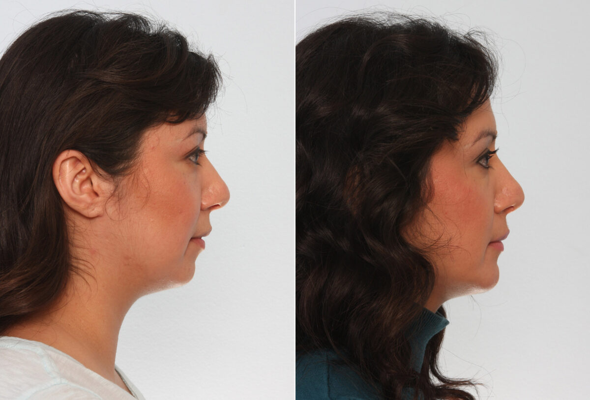 Chin Augmentation before and after photos in Houston, TX, Patient 28015