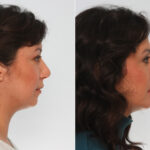 Chin Augmentation before and after photos in Houston, TX, Patient 28015