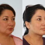Chin Augmentation before and after photos in Houston, TX, Patient 28020