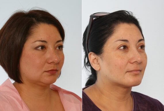 Chin Augmentation before and after photos in Houston, TX, Patient 28020