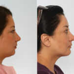 Chin Augmentation before and after photos in Houston, TX, Patient 28020