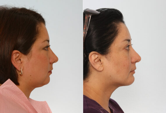 Chin Augmentation before and after photos in Houston, TX, Patient 28020