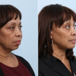 Chin Augmentation before and after photos in Houston, TX, Patient 28025