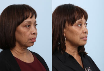 Chin Augmentation before and after photos in Houston, TX, Patient 28025