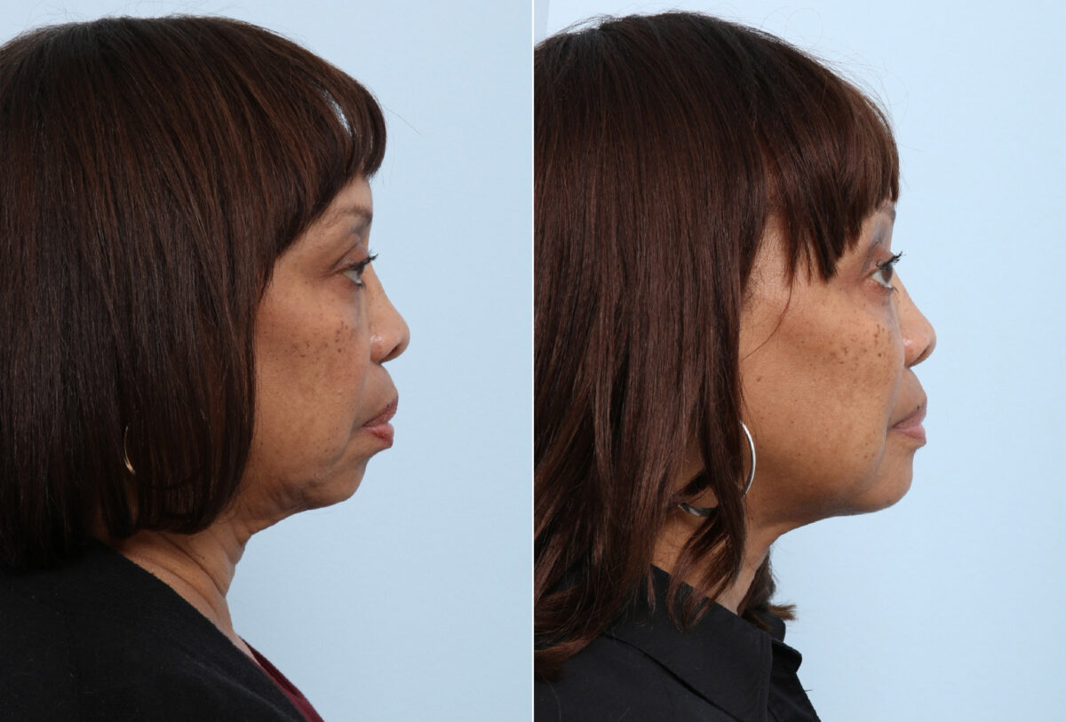 Chin Augmentation before and after photos in Houston, TX, Patient 28025