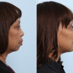 Chin Augmentation before and after photos in Houston, TX, Patient 28025