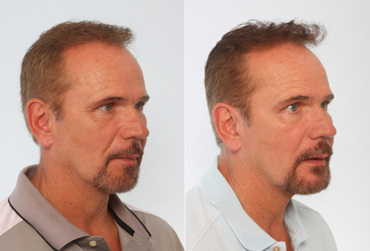 Chin Augmentation before and after photos in Houston, TX, Patient 28030