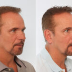 Chin Augmentation before and after photos in Houston, TX, Patient 28030