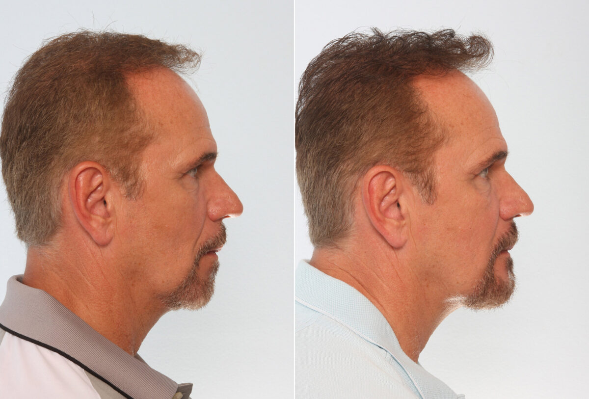 Chin Augmentation before and after photos in Houston, TX, Patient 28030