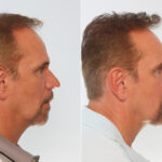 Chin Augmentation before and after photos in Houston, TX, Patient 28030