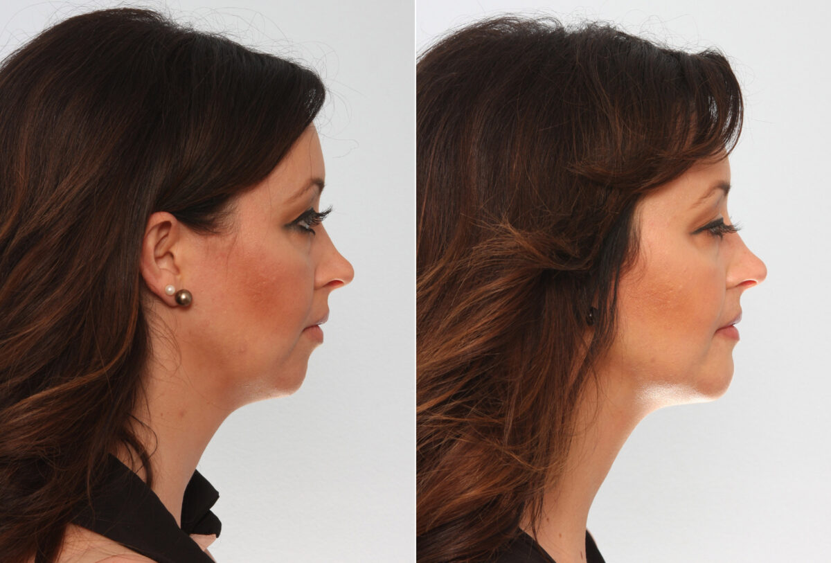 Chin Augmentation before and after photos in Houston, TX, Patient 28035