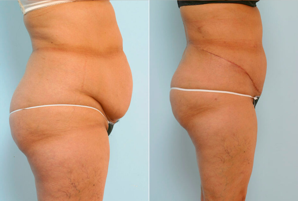 Abdominoplasty before and after photos in Houston, TX, Patient 24579