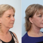 Chin Augmentation before and after photos in Houston, TX, Patient 28040