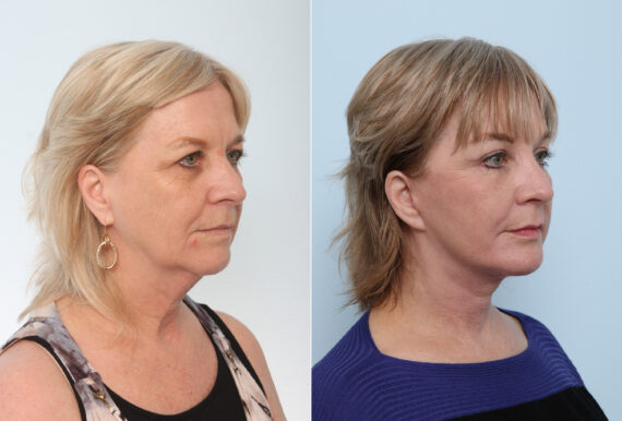 Chin Augmentation before and after photos in Houston, TX, Patient 28040