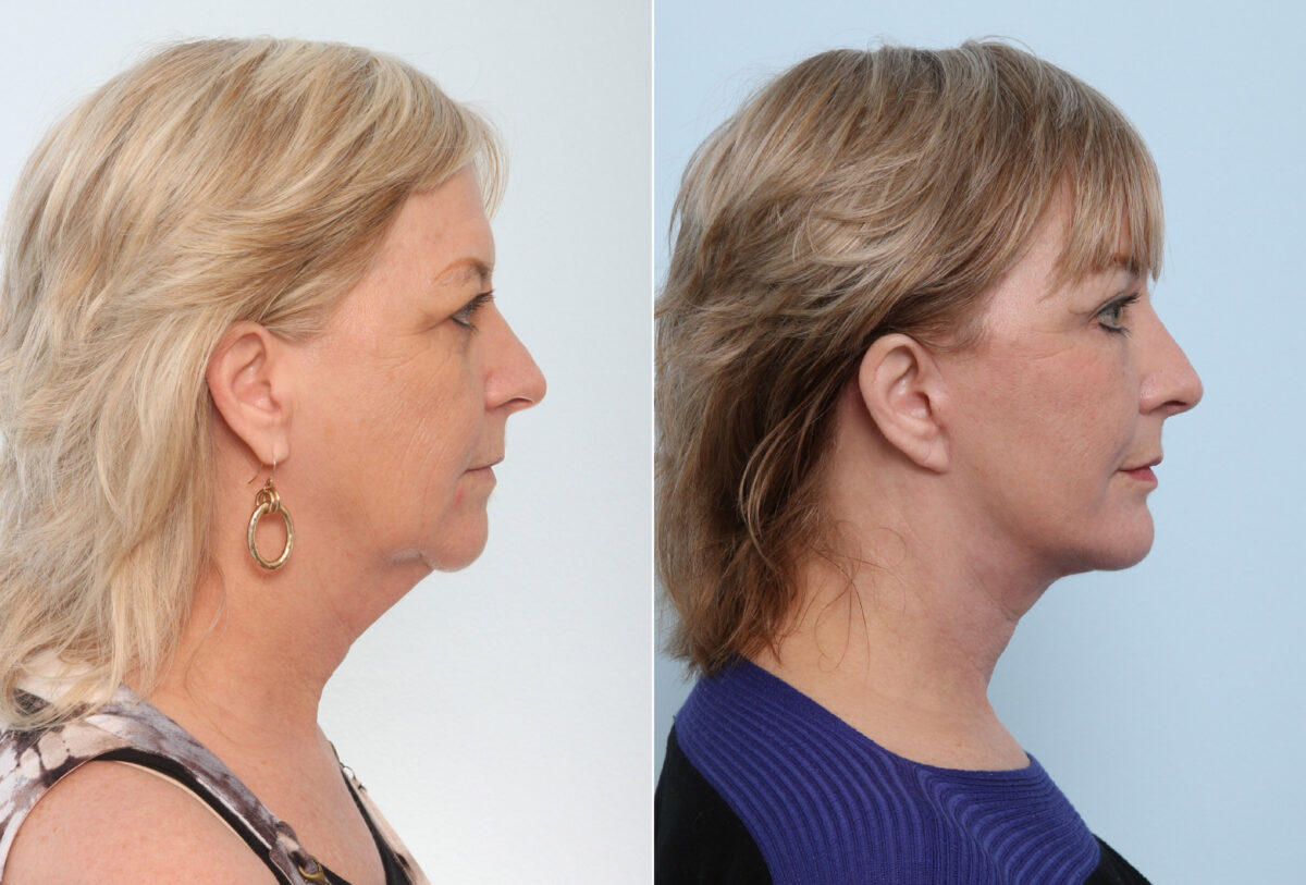 Chin Augmentation before and after photos in Houston, TX, Patient 28040