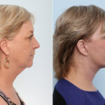 Chin Augmentation before and after photos in Houston, TX, Patient 28040