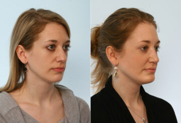 Chin Augmentation before and after photos in Houston, TX, Patient 28045