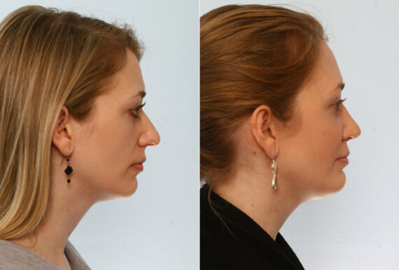 Chin Augmentation before and after photos in Houston, TX, Patient 28045