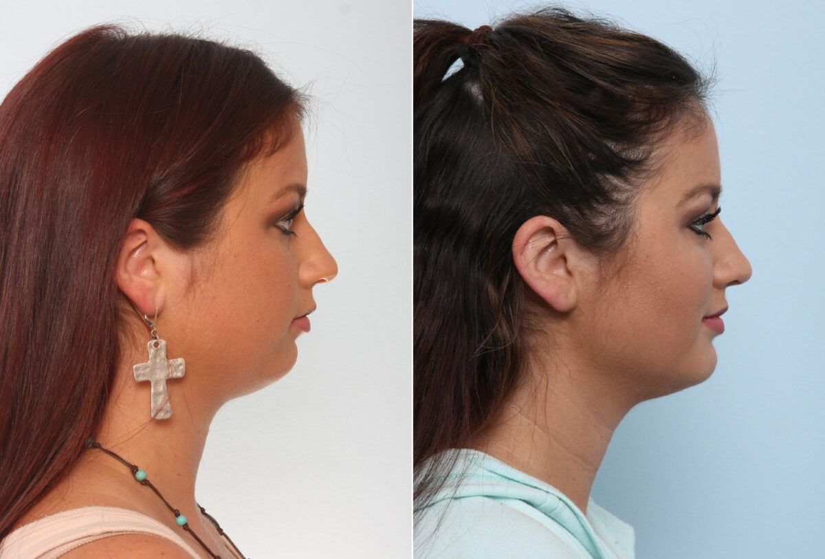 Chin Augmentation before and after photos in Houston, TX, Patient 28050