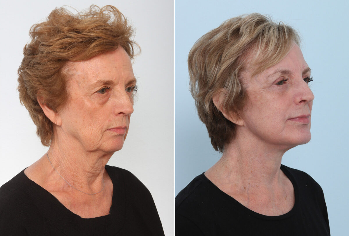 Chin Augmentation before and after photos in Houston, TX, Patient 28055