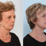 Chin Augmentation before and after photos in Houston, TX, Patient 28055