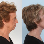 Chin Augmentation before and after photos in Houston, TX, Patient 28055