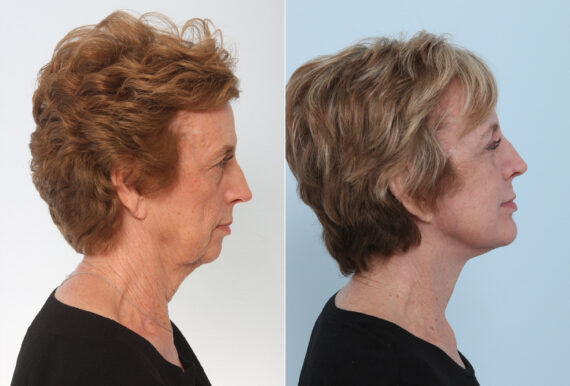 Chin Augmentation before and after photos in Houston, TX, Patient 28055