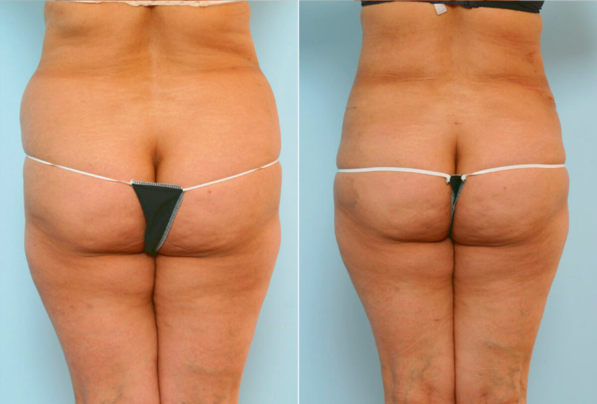 Abdominoplasty before and after photos in Houston, TX, Patient 24579