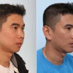 Chin Augmentation before and after photos in Houston, TX, Patient 28065