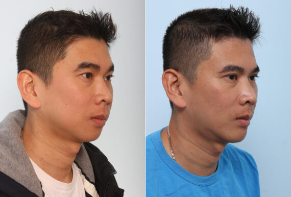 Chin Augmentation before and after photos in Houston, TX, Patient 28065