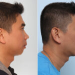 Chin Augmentation before and after photos in Houston, TX, Patient 28065