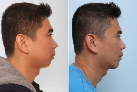 Chin Augmentation before and after photos in Houston, TX, Patient 28065