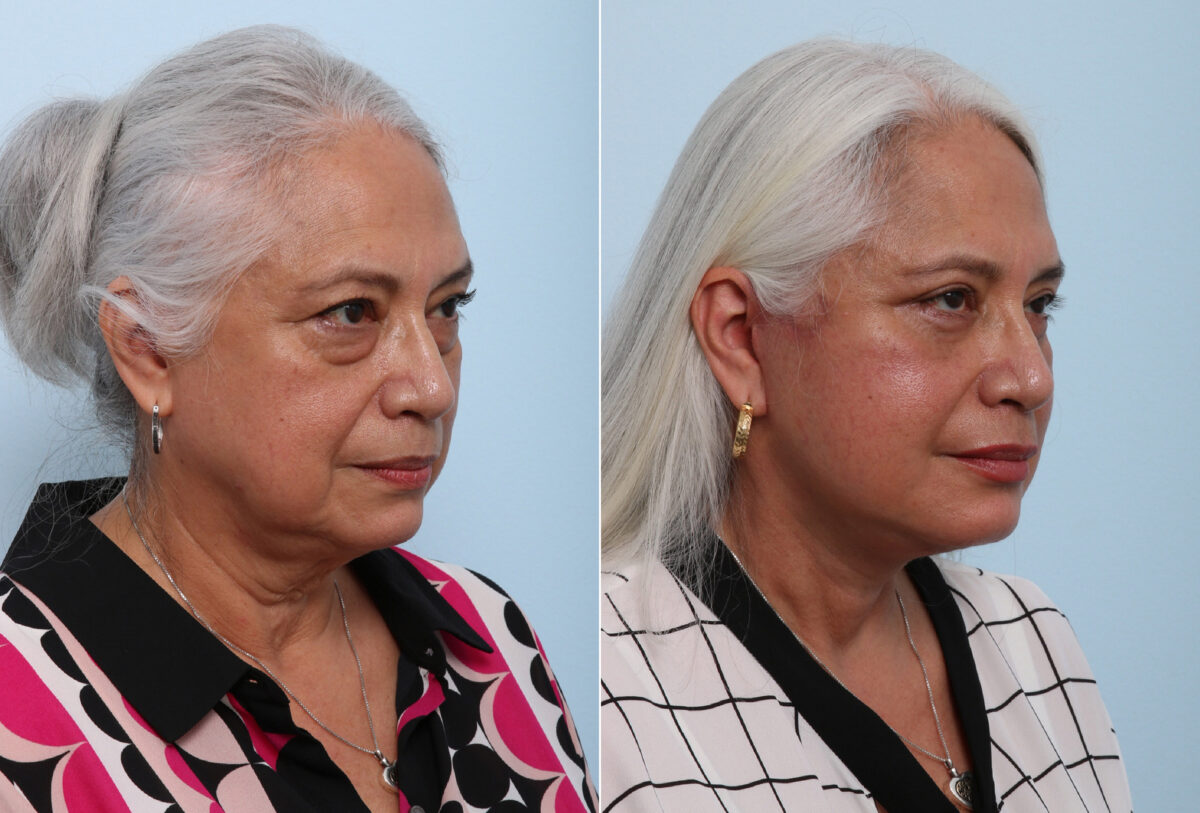 Chin Augmentation before and after photos in Houston, TX, Patient 28070