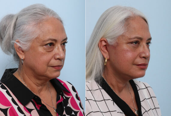 Chin Augmentation before and after photos in Houston, TX, Patient 28070