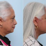Chin Augmentation before and after photos in Houston, TX, Patient 28070