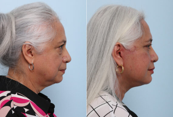 Chin Augmentation before and after photos in Houston, TX, Patient 28070