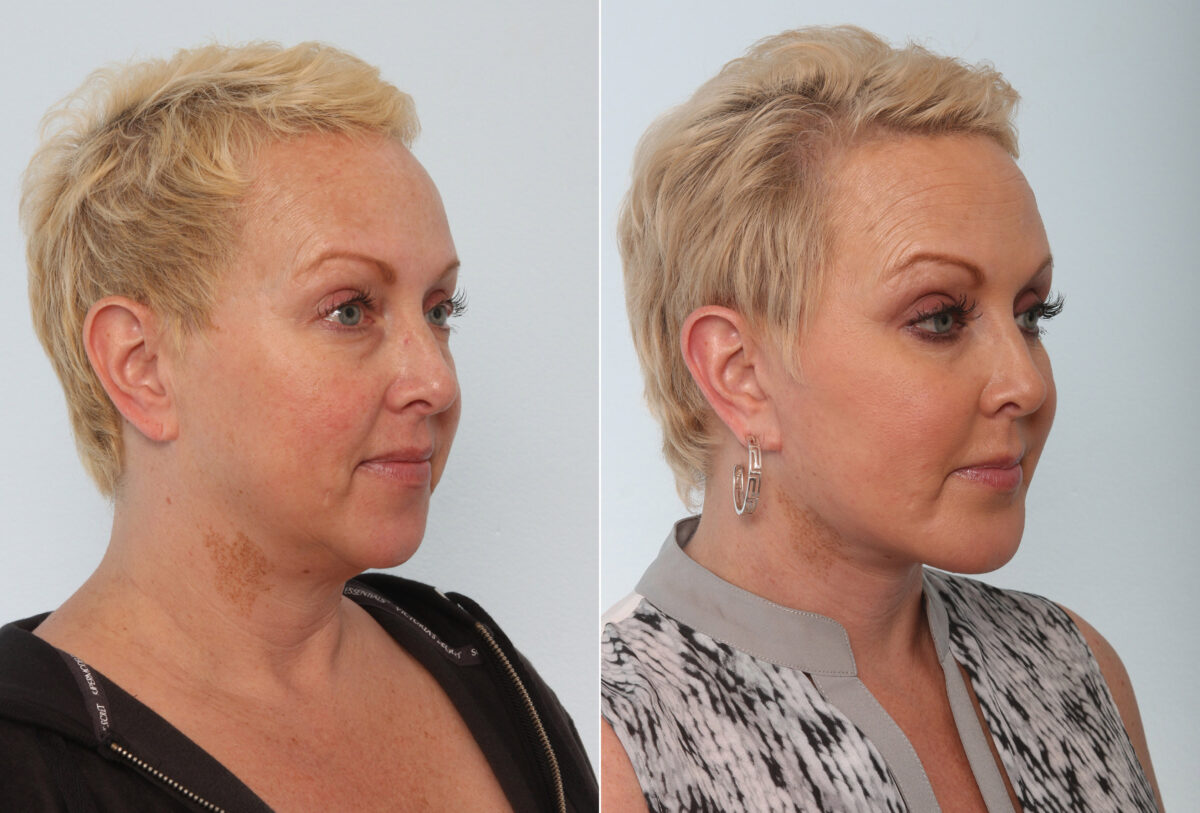 Chin Augmentation before and after photos in Houston, TX, Patient 28075