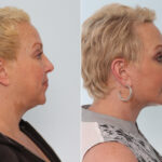 Chin Augmentation before and after photos in Houston, TX, Patient 28075