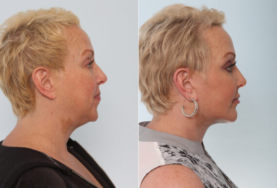 Chin Augmentation before and after photos in Houston, TX, Patient 28075