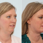 Chin Augmentation before and after photos in Houston, TX, Patient 28080
