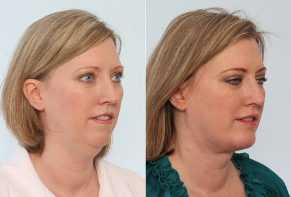 Chin Augmentation before and after photos in Houston, TX, Patient 28080