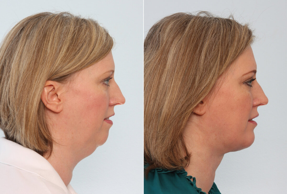 Chin Augmentation before and after photos in Houston, TX, Patient 28080