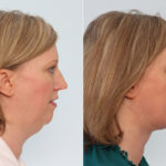 Chin Augmentation before and after photos in Houston, TX, Patient 28080