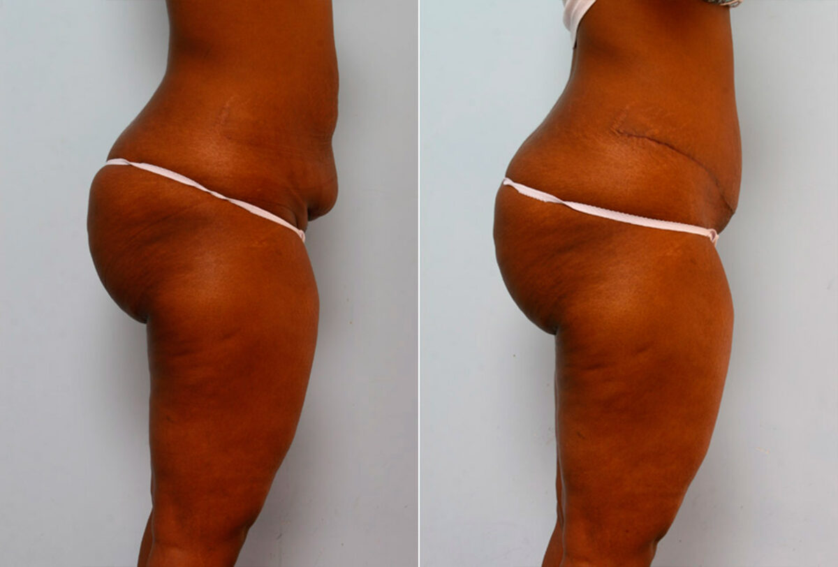 Abdominoplasty before and after photos in Houston, TX, Patient 24232