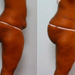 Abdominoplasty before and after photos in Houston, TX, Patient 24232